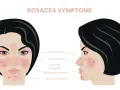 Rosacea-Symptome: Rötungen, sichtbare Blutgefäße, Papeln. Warum kein Hyaluron bei Rosacea? Die Haut ist empfindlich und braucht sanfte Pflege.