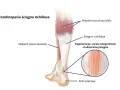 Anatomia podudzia człowieka z zaznaczonym ścięgnem Achillesa, mięśniami i kością piętową. Widoczna degeneracja ścięgna.