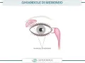 Illustrazione anatomica dell'occhio che evidenzia le ghiandole di Meibomio infiammate, responsabili della produzione del film lacrimale.