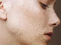 Nahaufnahme eines Gesichts mit starken Pigmentflecken, die sich wie ein Sternenhimmel über die Haut ziehen.
