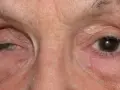 Primo piano degli occhi di una persona. L'occhio sinistro mostra segni di atrofia oculare, con la palpebra abbassata. L'occhio destro appare normale.