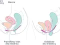 Prawidłowy stan dna miednicy vs. osłabione dno miednicy. Widoczna macica w tyłozgięciu, pęcherz i pochwa.