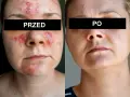 Przed i po: skóra z problemami, widoczne zmiany zapalne, a następnie wygładzona po zastosowaniu kremu na nużeńca.