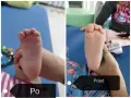 Dwie stopy dziecka, jedna po drugiej. Widać postęp w leczeniu szpotawych stóp.