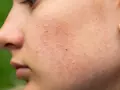 Skóra z licznymi białymi wągrami i zaczerwienieniami, widoczne fragmenty nosa i ust.