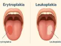 Objawy raka jamy ustnej: erytroplakia (czerwona plama) i leukoplakia (biała plama) na języku.