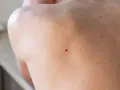 Zbliżenie na skórę pleców z widocznym naczyniakiem rubinowym.