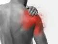 Ból barku, objaw capsulitis adhesiva, zaznaczony czerwienią.