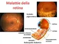 Immagini di malattie retiniche, tra cui la retinite pigmentosa e la retinopatia diabetica, che mostrano difetti dell'epitelio pigmentato retinico, emorragie e vasi sanguigni alterati.