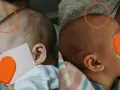 Dwa ujęcia główki niemowlaka. Na pierwszym widać delikatne nierówności na ciemiączku, na drugim ciemiączko jest gładkie.