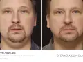 Przed i po zabiegu lipolizy podbródka. Widoczna redukcja tkanki tłuszczowej i poprawa napięcia skóry.