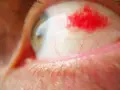 Un occhio umano con la sclera arrossata e una macchia di sangue visibile. Le ciglia sono sfocate in primo piano, mentre l'iride verde-marrone è parzialmente visibile.