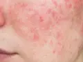Primo piano del viso con evidenti rossori e imperfezioni cutanee, che suggeriscono una condizione come la rosacea o l'acne.