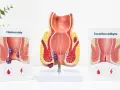 Model anatomiczny odbytu z widoczną szczeliną odbytu i hemoroidami. Obrazek po prawej pokazuje szczelinę odbytu, a po lewej hemoroidy.