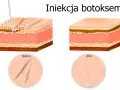 Ilustracja pokazuje iniekcję botoksu, która wygładza zmarszczki. Zastanawiasz się, ktory botox jest najlepszy?