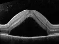 OCT di occhio con corioretinopatia sierosa centrale. Evitare stress e cortisone per non peggiorare la condizione.