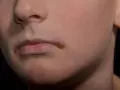 Zajady na ustach, które mogą świadczyć o braku witaminy. Widoczne pęknięcia i zaczerwienienie w kącikach ust.