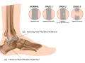 Illustration des différents stades d'une entorse du pied, du ligament sain au ligament rompu.
