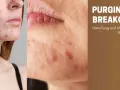 Close-up of a face with acne, showing breakouts after starting a new skincare routine. Text reads "PURGING VS. BREAKOUTS: Identifying and Managing Your Skin's Response.