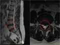 Obraz MRI kręgosłupa lędźwiowego z widoczną protruzją krążka międzykręgowego, zaznaczoną na czerwono.