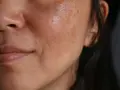 Primo piano del viso di una donna con evidenti macchie solari e discromie sulla pelle.