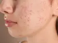 Nahaufnahme einer Wange mit Rötungen und Pickelchen, die auf Akne vulgaris hindeuten.