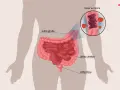 Ilustracja przedstawia jelito grube i cienkie, z powiększeniem pokazującym krew w stolcu, która może być objawem problemów z odbytnicą.
