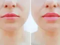 Przed i po zabiegu lip lift. Usta po zabiegu są pełniejsze i bardziej wyraziste, co podkreśla ich naturalne piękno.