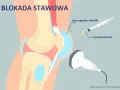 Ilustracja przedstawia blokadę stawową kolana. Zastrzyki w kolano z kortykosteroidem pod kontrolą USG pomagają przy stanie zapalnym kaletki.