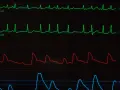 Monitor EKG pokazuje nieregularne fale, sugerujące migotanie przedsionków. Widoczne są również linie ciśnienia krwi i pulsoksymetrii.