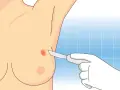 Ręka w rękawiczce wykonuje biopsję gruboigłową podejrzanej zmiany na piersi.