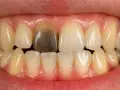Ciemny, przebarwiony ząb może świadczyć o tym, jak sprawdzić czy ząb jest martwy. Zmiana koloru to sygnał, by udać się do dentysty.