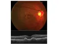 Immagine OCT e fondo oculare che mostrano segni di degenerazione maculare, il cui significato è cruciale per la diagnosi.