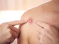Palce wskazują na zaczerwienioną zmianę skórną z żółtym czubkiem. Jak odróżnić czyraka od pryszcza?