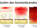 Illustrationen zeigen Hautschichten bei Sonnenbrand 1., 2. und 3. Grades. Der Sonnenbrand 2. Grades zeigt Blasenbildung in der Epidermis und Rötung der Dermis.