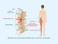 Illustration zeigt Bandscheibenvorfall, der Ischiasnerv reizt. Schmerz strahlt vom Rücken ins Bein aus. Mögliche Linderung durch Ischias Medikamente.