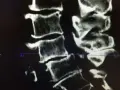 Radiographie montrant l'arthrose cervicale d'un cheval, avec des signes de dégénérescence osseuse au niveau des vertèbres.