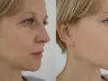 Porównanie skóry przed i po zabiegu z użyciem egzosomów: widoczna poprawa tekstury i kolorytu cery.