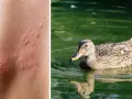 Haut mit roten Pusteln, die auf einen Zerkarien Ausschlag hindeuten, neben einer Ente im Wasser.