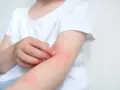 Dziecko drapie zaczerwienioną skórę na ramieniu, widoczne objawy alergii.