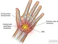 Anatomia dłoni z zaznaczonymi obszarami bólu nadgarstka: zapalenie ścięgien kciuka, zginaczy i prostowników.