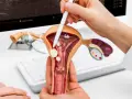 Model narządu rodnego kobiety z widocznymi mięśniakami, które mogą powodować ciągłe uczucie parcia w pochwie.