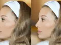 Profil kobiety z opaską na włosach, porównanie przed i po. Widoczna subtelna zmiana nosa, 2 tygodnie po operacji nosa.