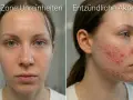 Zwei Bilder einer jungen Frau mit unreiner Haut. Links: T-Zone mit Rötungen und Pickelchen. Rechts: Entzündliche Akne im Gesicht.
