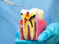 Model zęba z widocznym ubytkiem i narzędziem dentystycznym. Zastanawiasz się nad leczeniem kanałowym? Cena może być niższa niż myślisz.