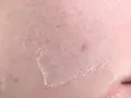 Close-up of dry, flaky skin with peeling patches, indicating what causes transepidermal water loss.