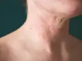 Close-up of a person's neck with red, inflamed eczema. Some find relief from itching, wondering why does hot water feel good on eczema.
