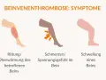 Rötung, Schmerzen und Schwellung am Bein sind Symptome, die auf eine Thrombose hinweisen können. Achte auf diese Anzeichen!