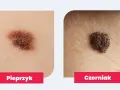 Dlaczego pieprzyk boli jak pryszcz? Objawy, które mogą niepokoić