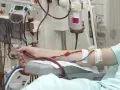 Ramię pacjenta podłączone do maszyny do dializy. Czerwone wężyki prowadzą krew do aparatu, który oczyszcza ją podczas dializy.